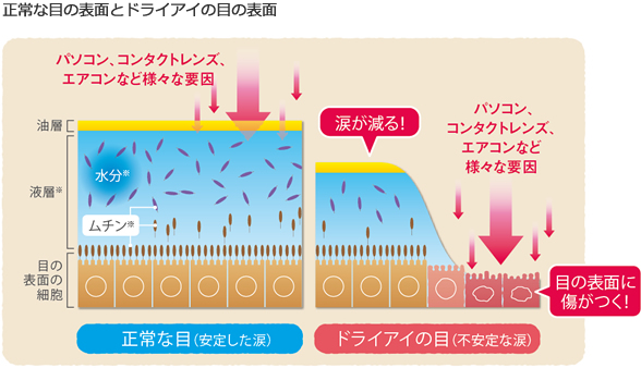 ドライアイ