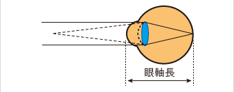 近視(眼軸長)