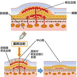 抗VEGF