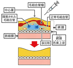 2抗VEGF阻害剤硝子体内注射