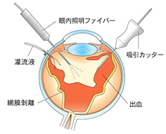 3硝子体手術