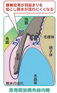 緑内障 治る